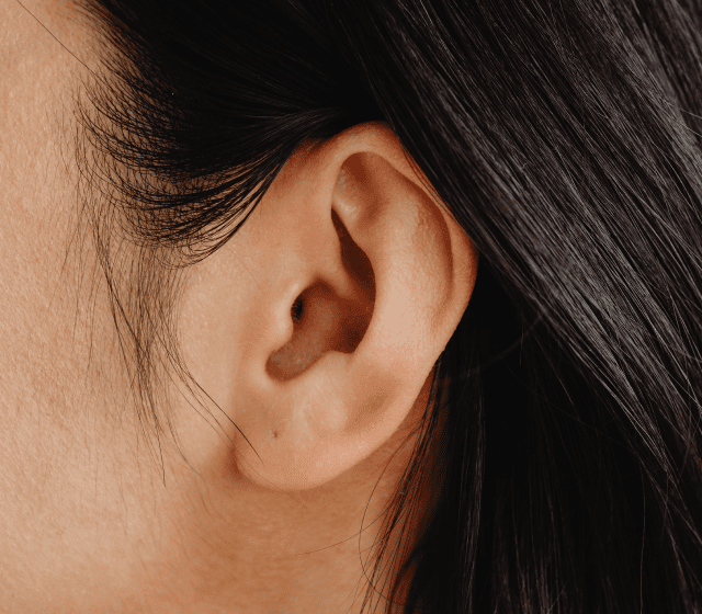 (Otoplasty) Ear Setback